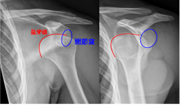肩关节脱臼常见问题| 肩部| 医生文章| 亚洲专科医生